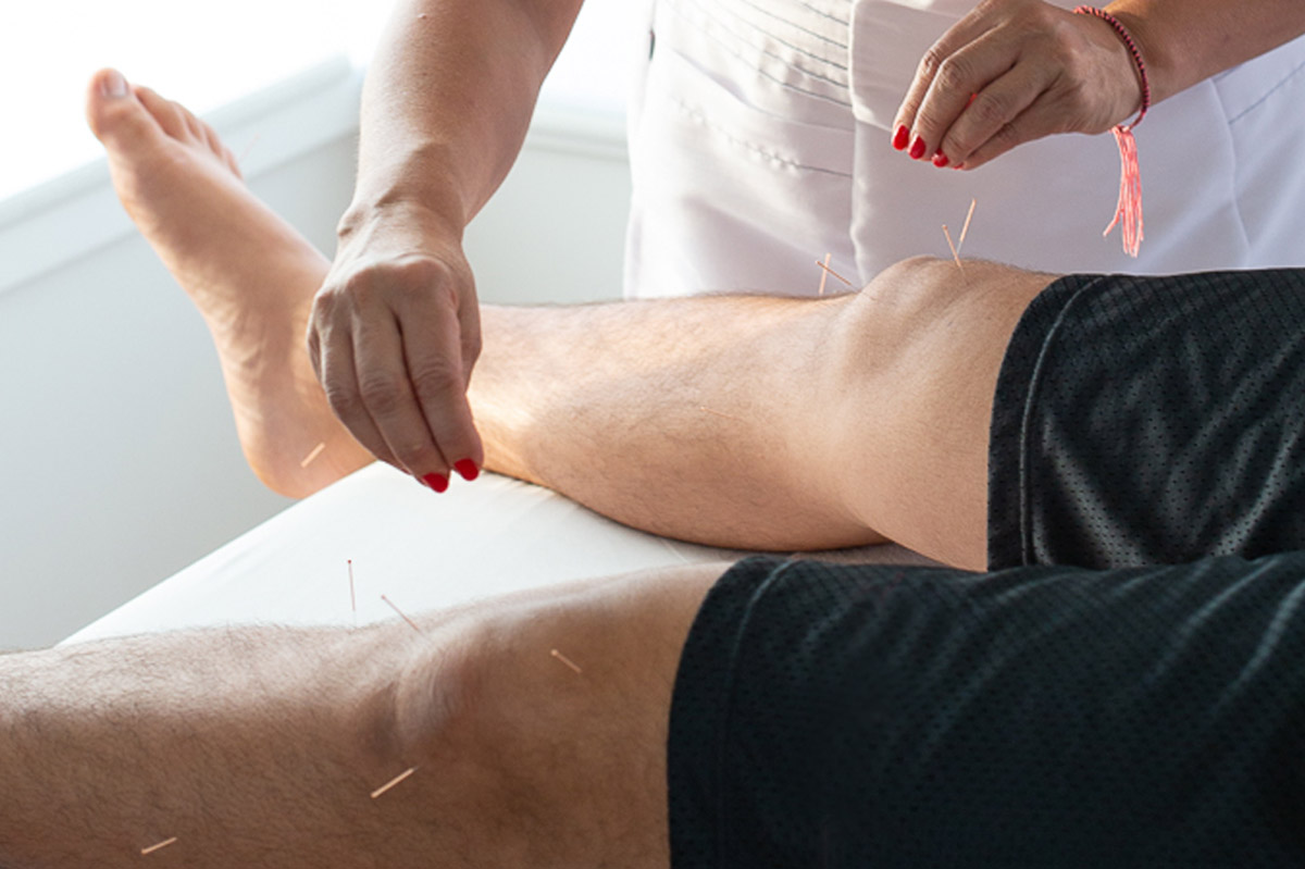 ¿Funciona realmente la acupuntura?